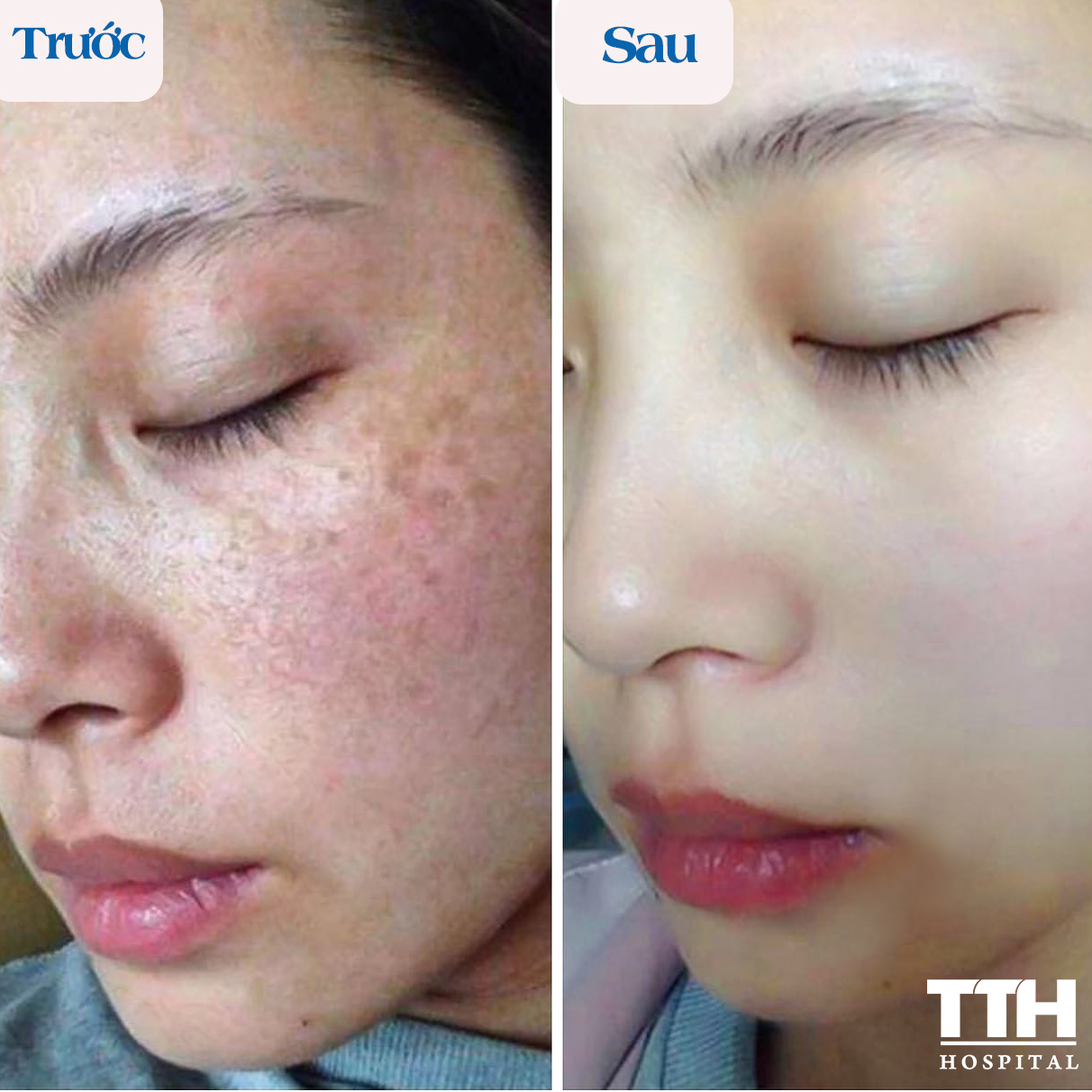 Điều trị nám công nghệ Q10 Prenium